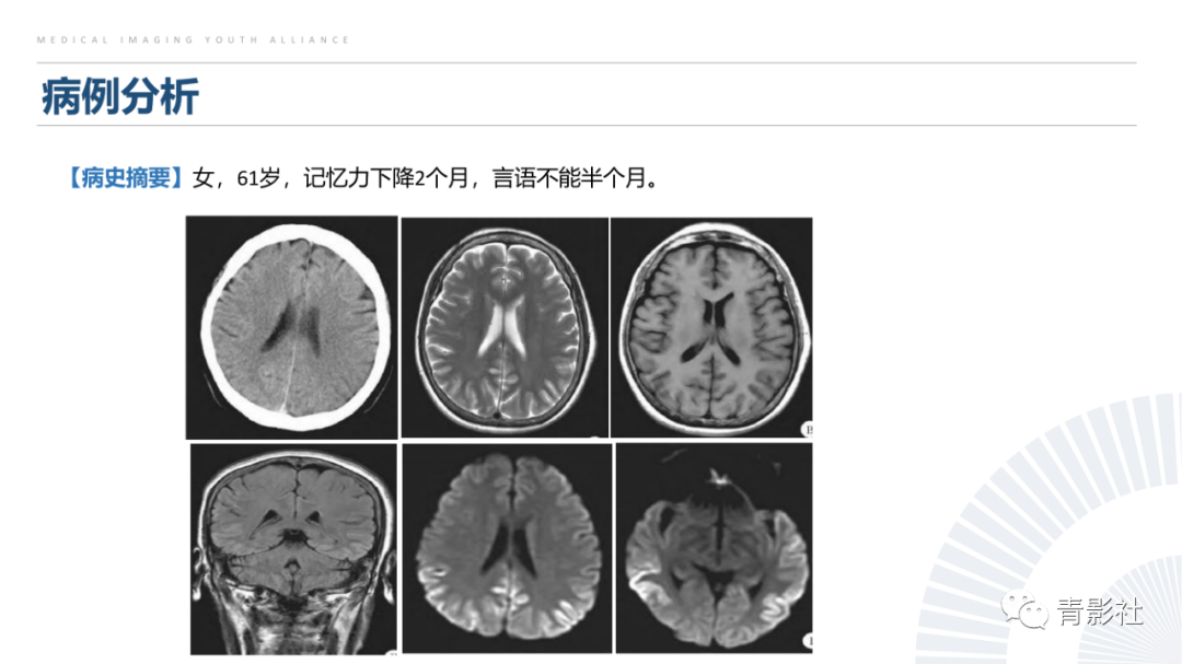 影像PPT - 【PPT】克雅氏病（Creutzfeldt-Jakob Disease）的影像诊断思路-27