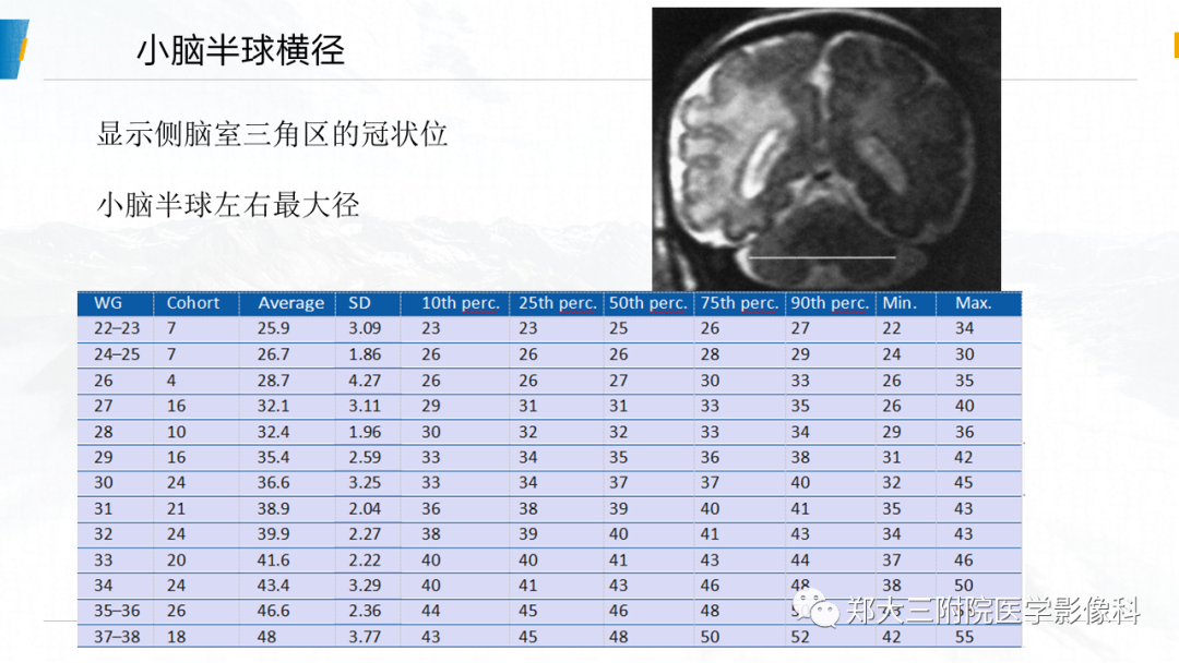 影像PPT - 【PPT】胎儿MRI颅脑径线测量标准-14