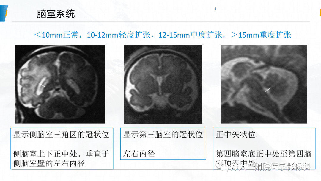 影像PPT - 【PPT】胎儿MRI颅脑径线测量标准-15