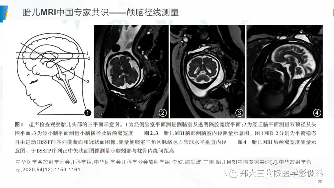 影像PPT - 【PPT】胎儿MRI颅脑径线测量标准-20