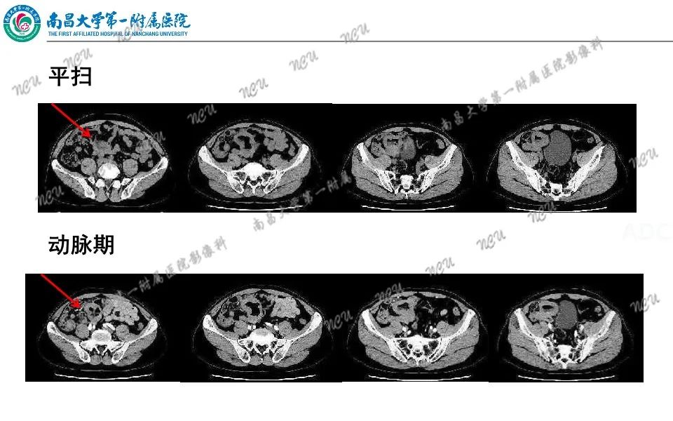 影像PPT - 【PPT】原发小肠淋巴瘤-3