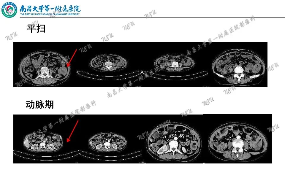 影像PPT - 【PPT】原发小肠淋巴瘤-9