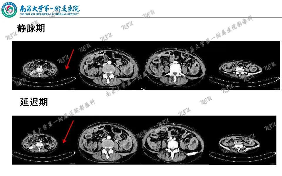 影像PPT - 【PPT】原发小肠淋巴瘤-10
