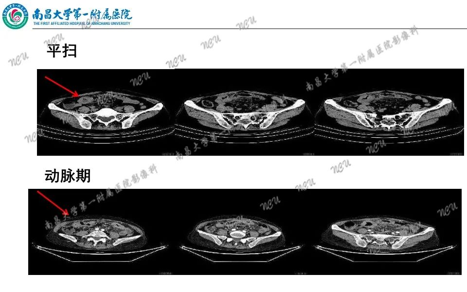 影像PPT - 【PPT】原发小肠淋巴瘤-14