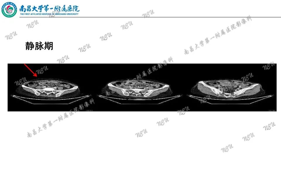 影像PPT - 【PPT】原发小肠淋巴瘤-15
