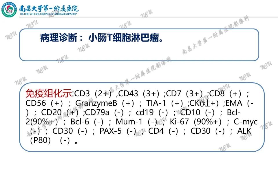 影像PPT - 【PPT】原发小肠淋巴瘤-17