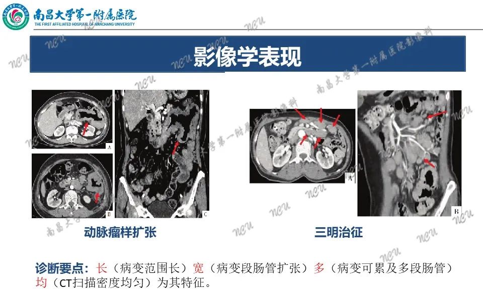 影像PPT - 【PPT】原发小肠淋巴瘤-24