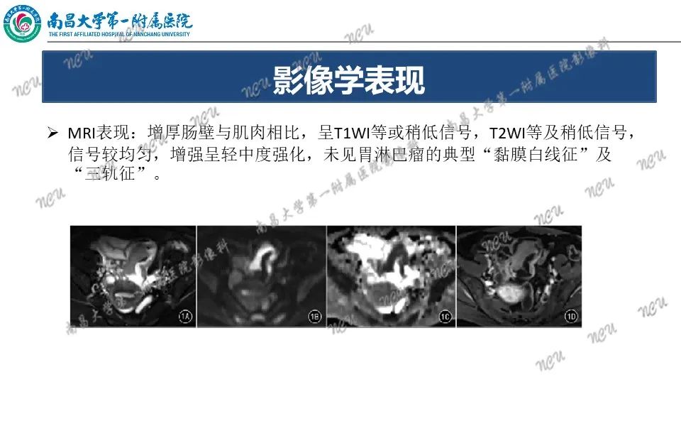 影像PPT - 【PPT】原发小肠淋巴瘤-25