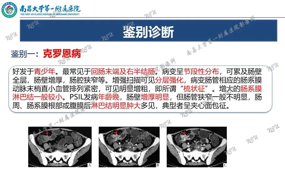 影像PPT - 【PPT】原发小肠淋巴瘤-27