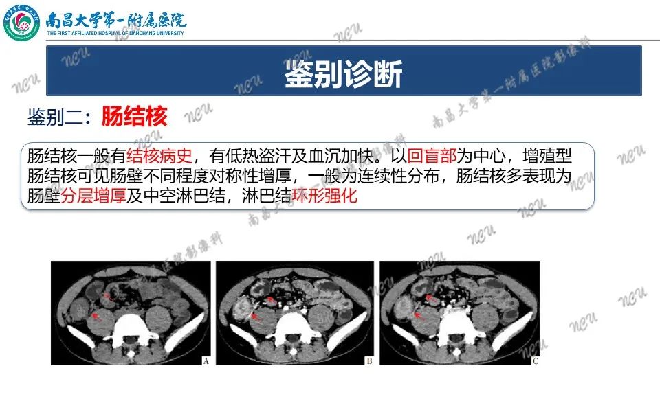 影像PPT - 【PPT】原发小肠淋巴瘤-28