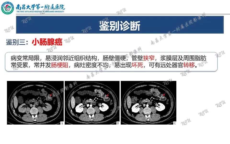 影像PPT - 【PPT】原发小肠淋巴瘤-29