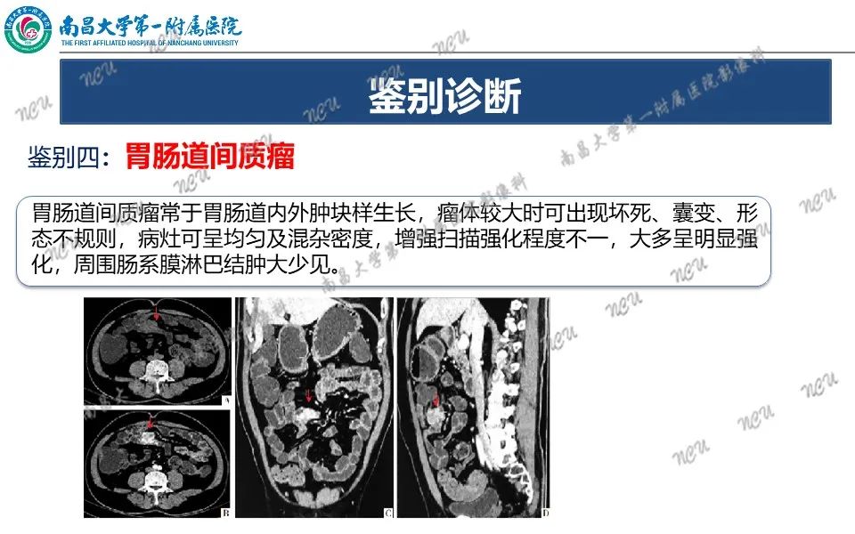 影像PPT - 【PPT】原发小肠淋巴瘤-30