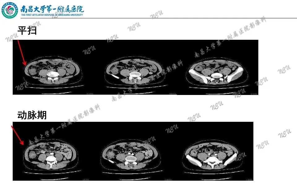 影像PPT - 【PPT】原发小肠淋巴瘤-32