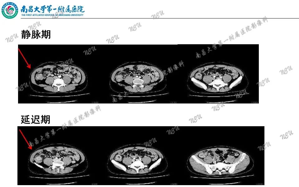 影像PPT - 【PPT】原发小肠淋巴瘤-33