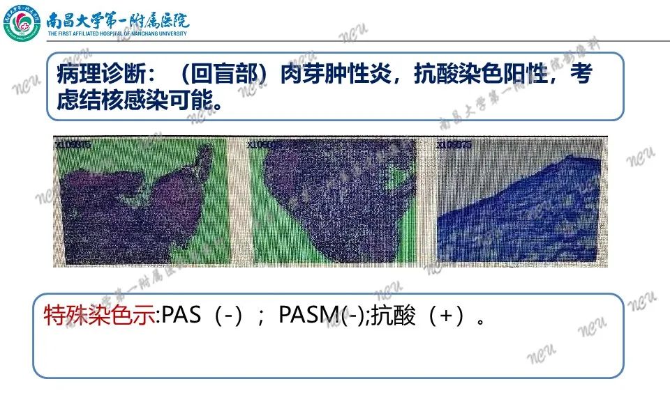 影像PPT - 【PPT】原发小肠淋巴瘤-36
