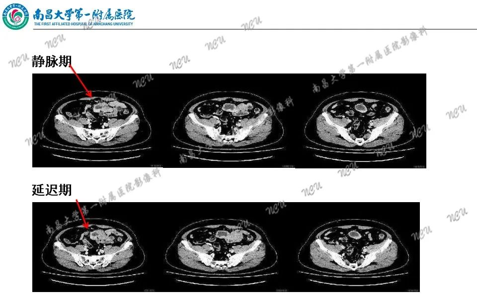 影像PPT - 【PPT】原发小肠淋巴瘤-39