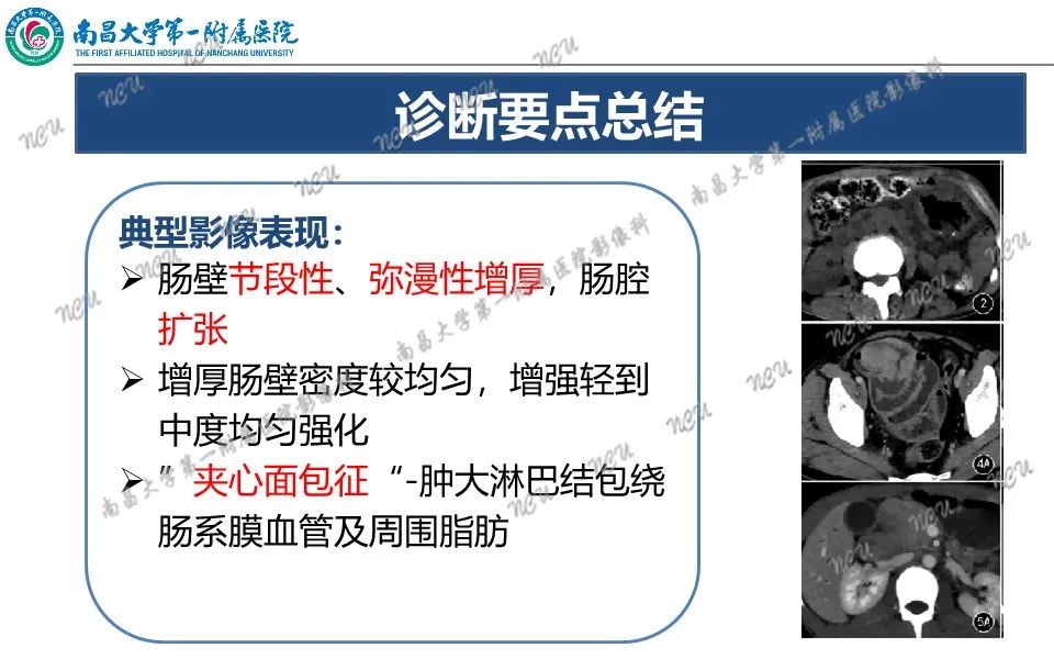 影像PPT - 【PPT】原发小肠淋巴瘤-48
