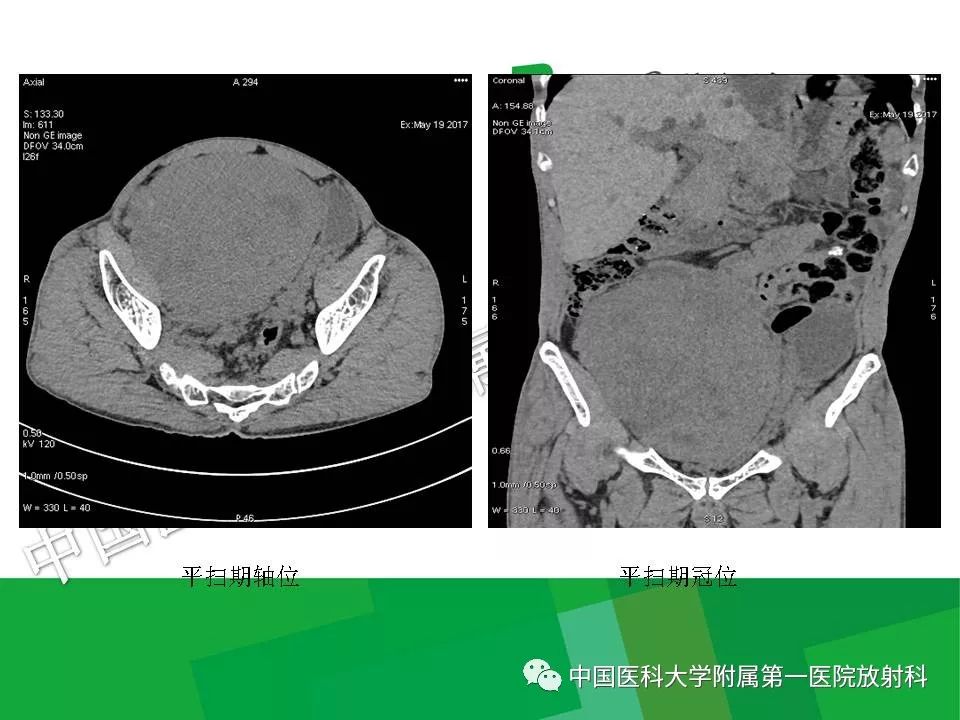 影像PPT - 【PPT】腹膜后孤立性纤维性肿瘤-7