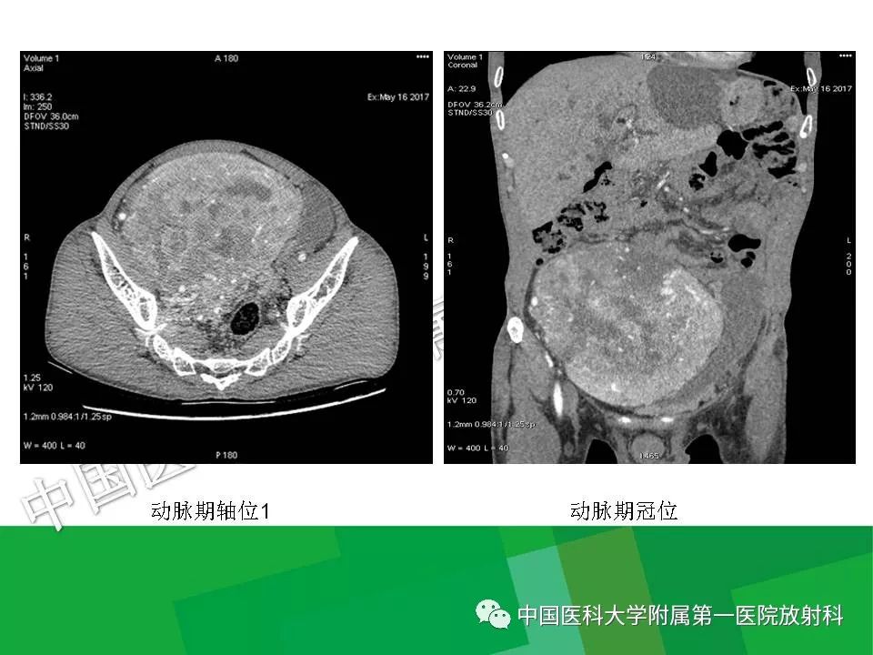 影像PPT - 【PPT】腹膜后孤立性纤维性肿瘤-8