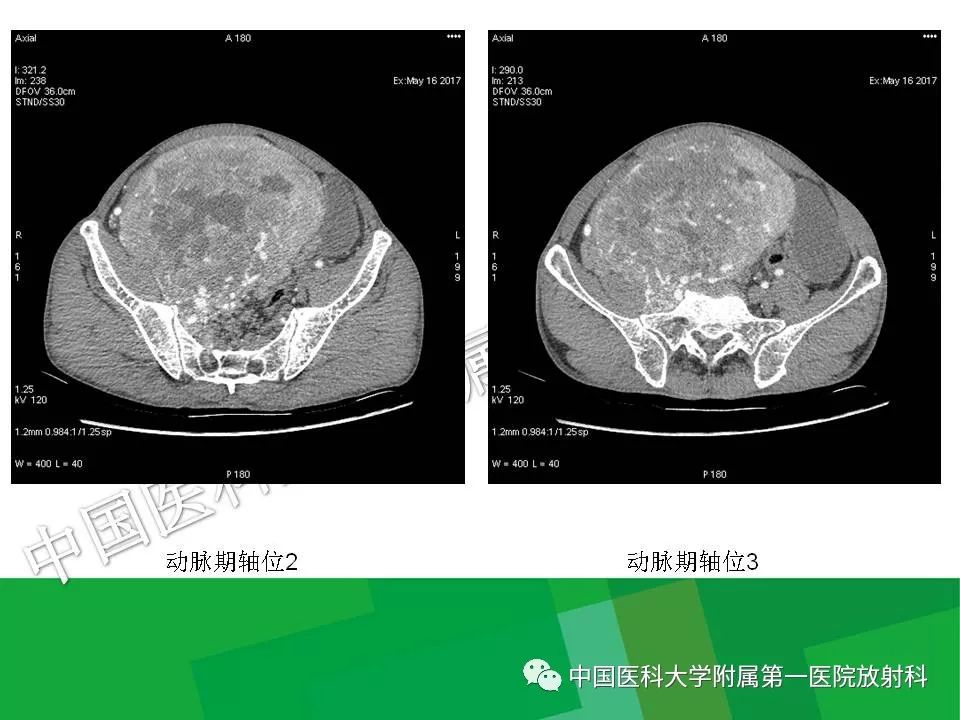 影像PPT - 【PPT】腹膜后孤立性纤维性肿瘤-9