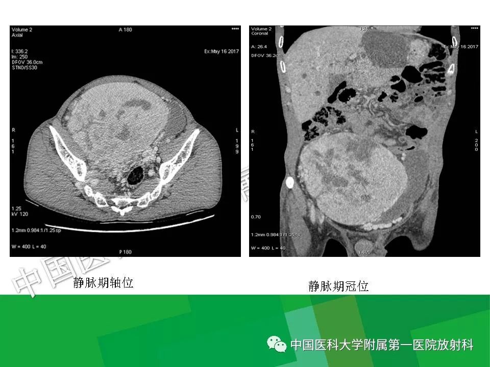 影像PPT - 【PPT】腹膜后孤立性纤维性肿瘤-10