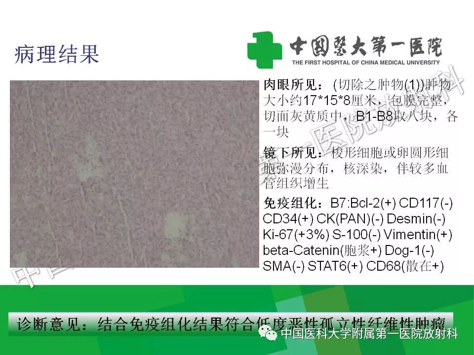影像PPT - 【PPT】腹膜后孤立性纤维性肿瘤-11