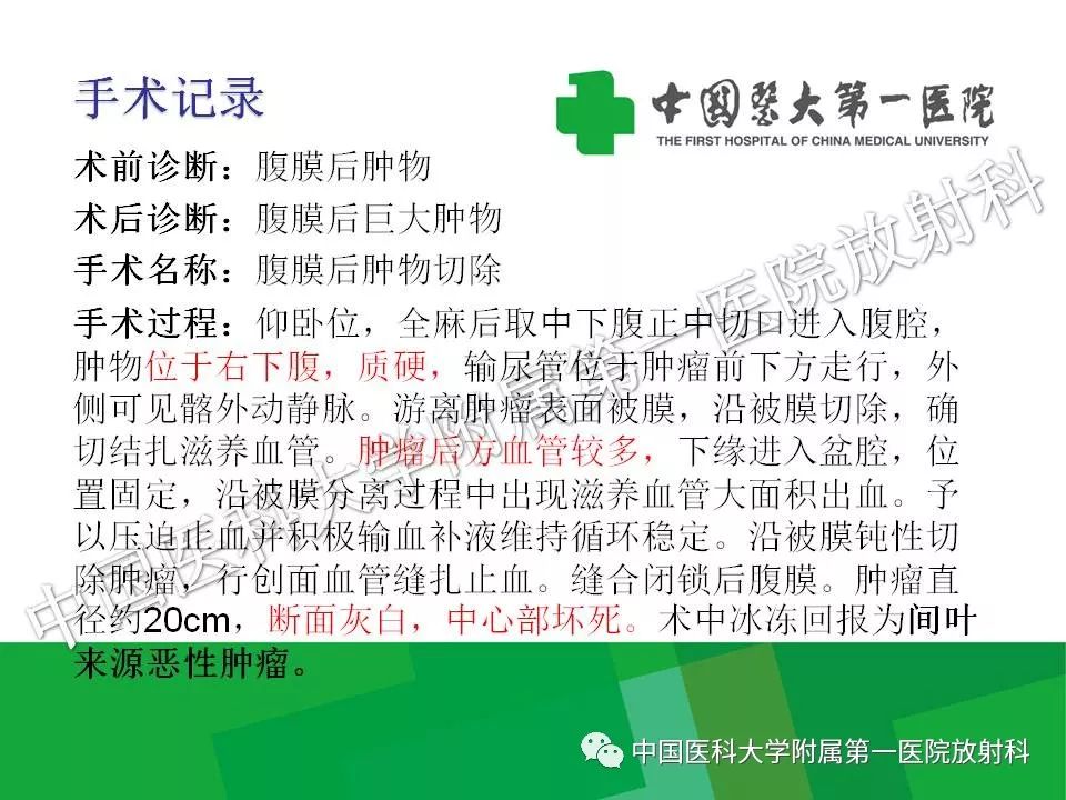 影像PPT - 【PPT】腹膜后孤立性纤维性肿瘤-12