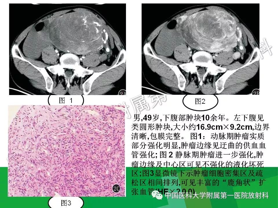影像PPT - 【PPT】腹膜后孤立性纤维性肿瘤-16