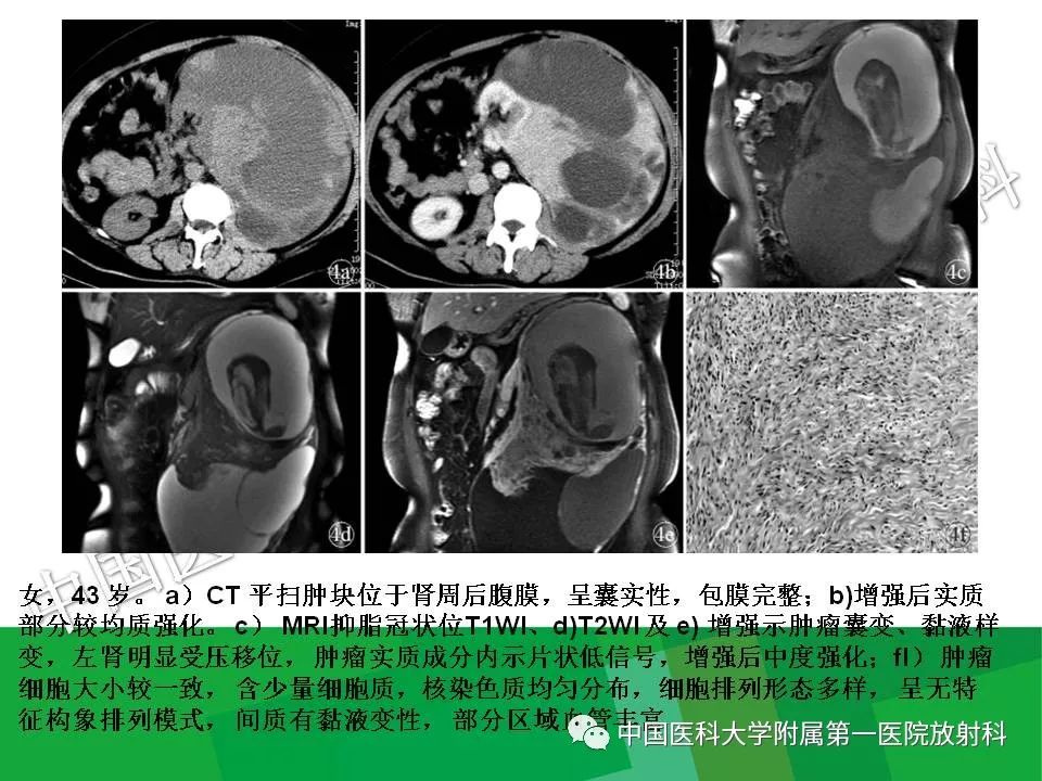影像PPT - 【PPT】腹膜后孤立性纤维性肿瘤-17