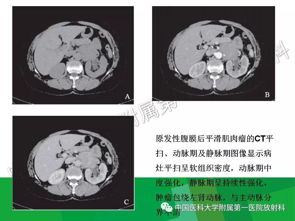 影像PPT - 【PPT】腹膜后孤立性纤维性肿瘤-23