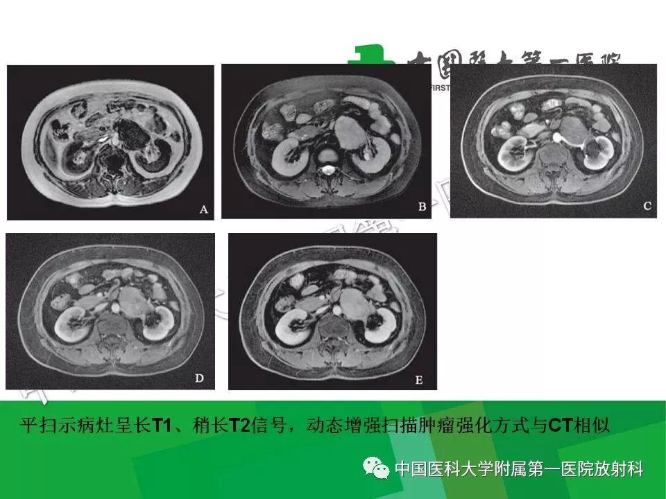 影像PPT - 【PPT】腹膜后孤立性纤维性肿瘤-24
