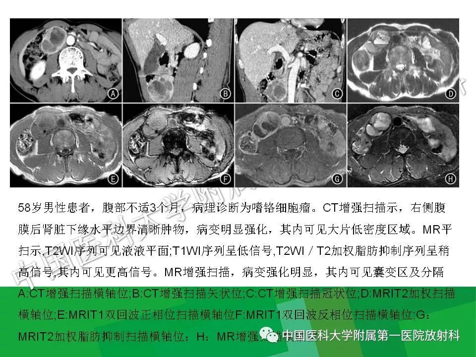 影像PPT - 【PPT】腹膜后孤立性纤维性肿瘤-21