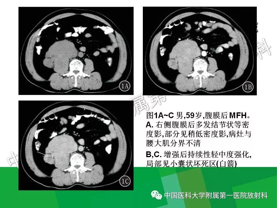 影像PPT - 【PPT】腹膜后孤立性纤维性肿瘤-27