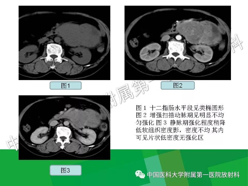影像PPT - 【PPT】腹膜后孤立性纤维性肿瘤-30