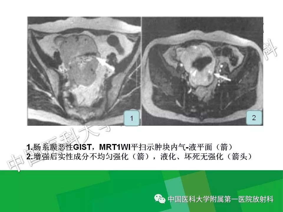 影像PPT - 【PPT】腹膜后孤立性纤维性肿瘤-31