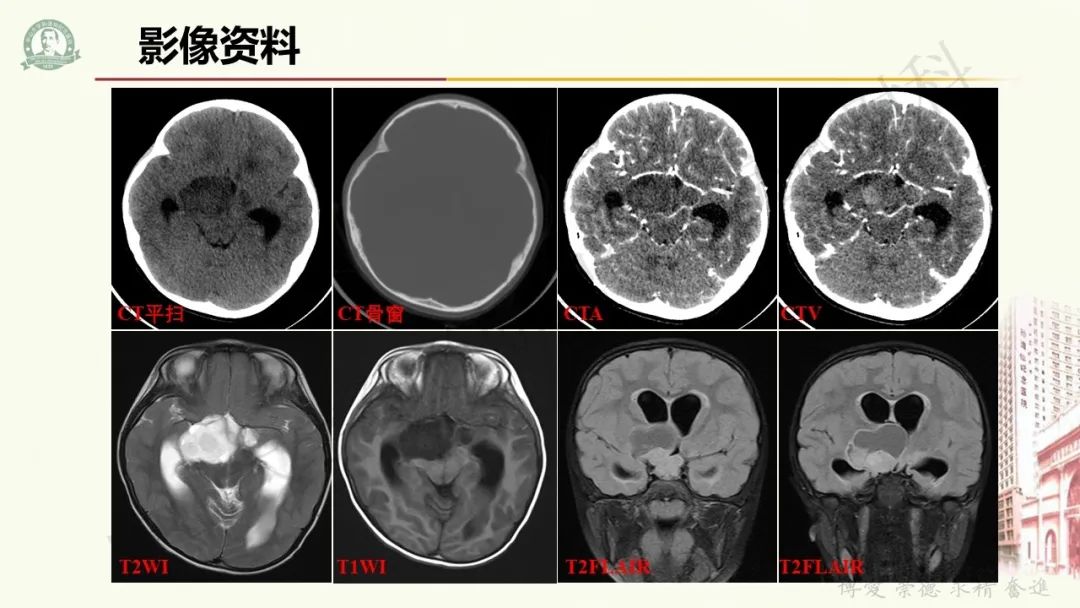 影像PPT - 【病例】毛细胞黏液样星形细胞瘤1例CT及MR影像-3