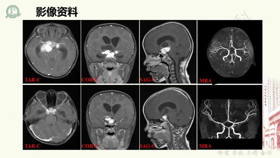 影像PPT - 【病例】毛细胞黏液样星形细胞瘤1例CT及MR影像-4