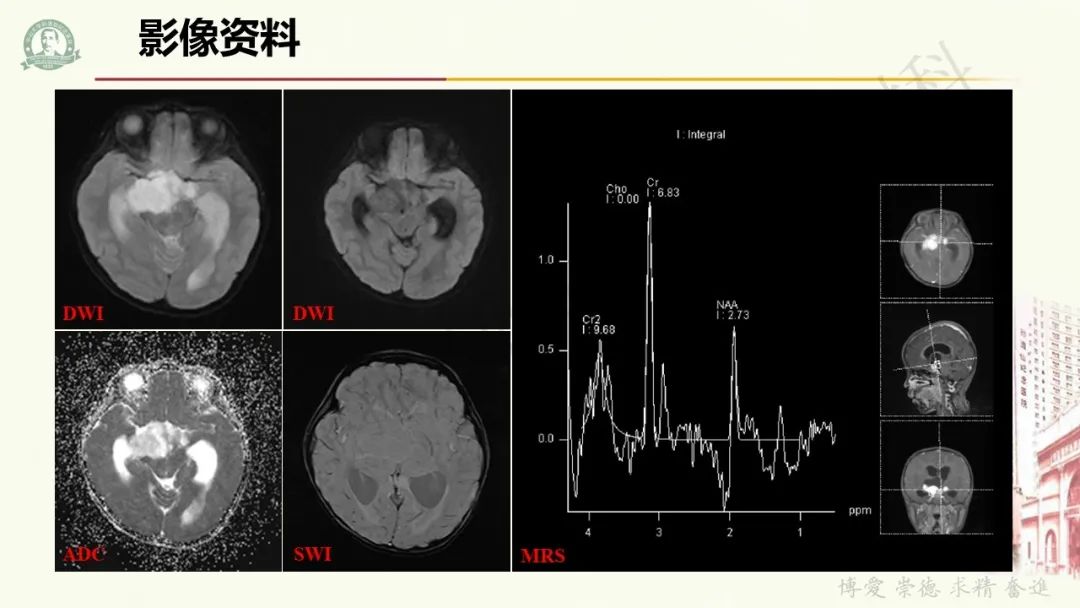 影像PPT - 【病例】毛细胞黏液样星形细胞瘤1例CT及MR影像-5