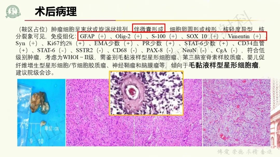 影像PPT - 【病例】毛细胞黏液样星形细胞瘤1例CT及MR影像-7