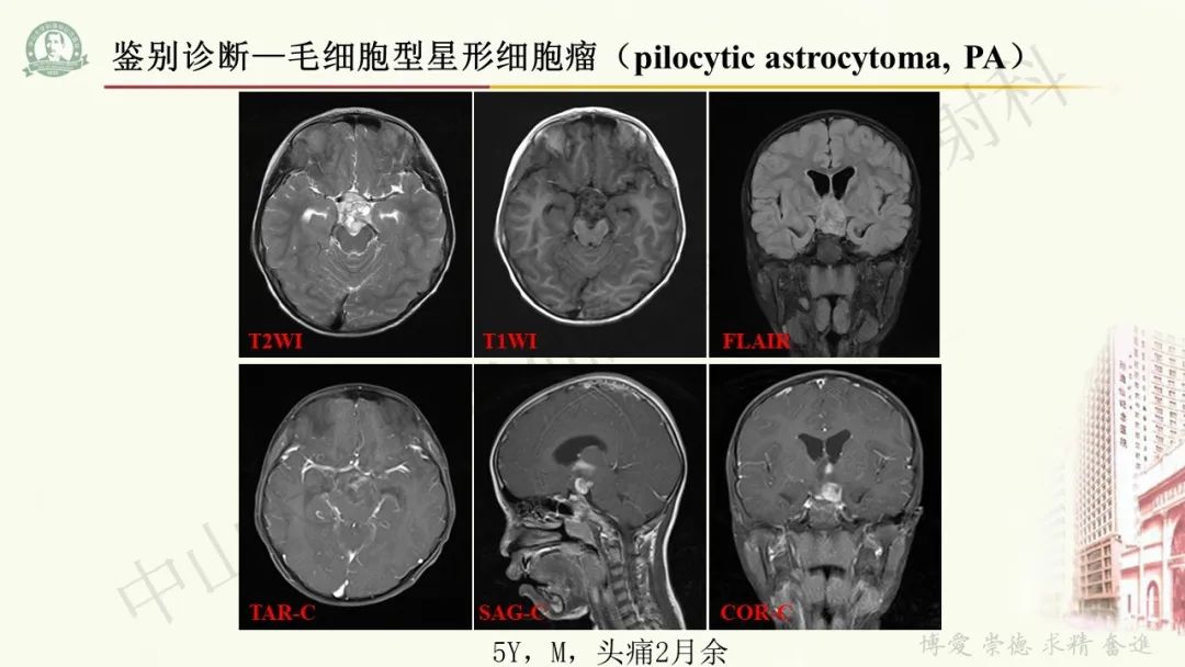 影像PPT - 【病例】毛细胞黏液样星形细胞瘤1例CT及MR影像-13