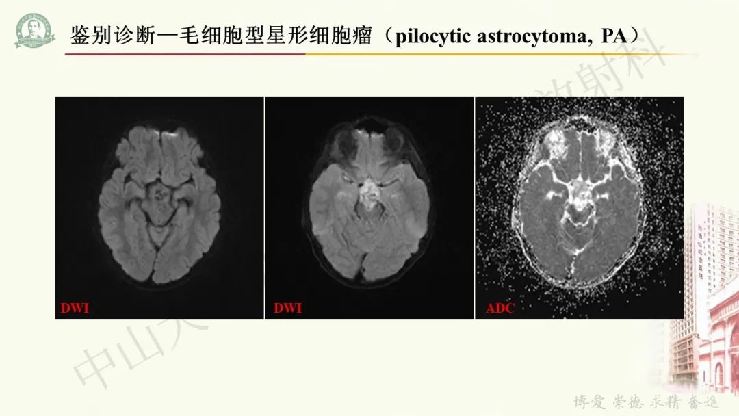 影像PPT - 【病例】毛细胞黏液样星形细胞瘤1例CT及MR影像-14