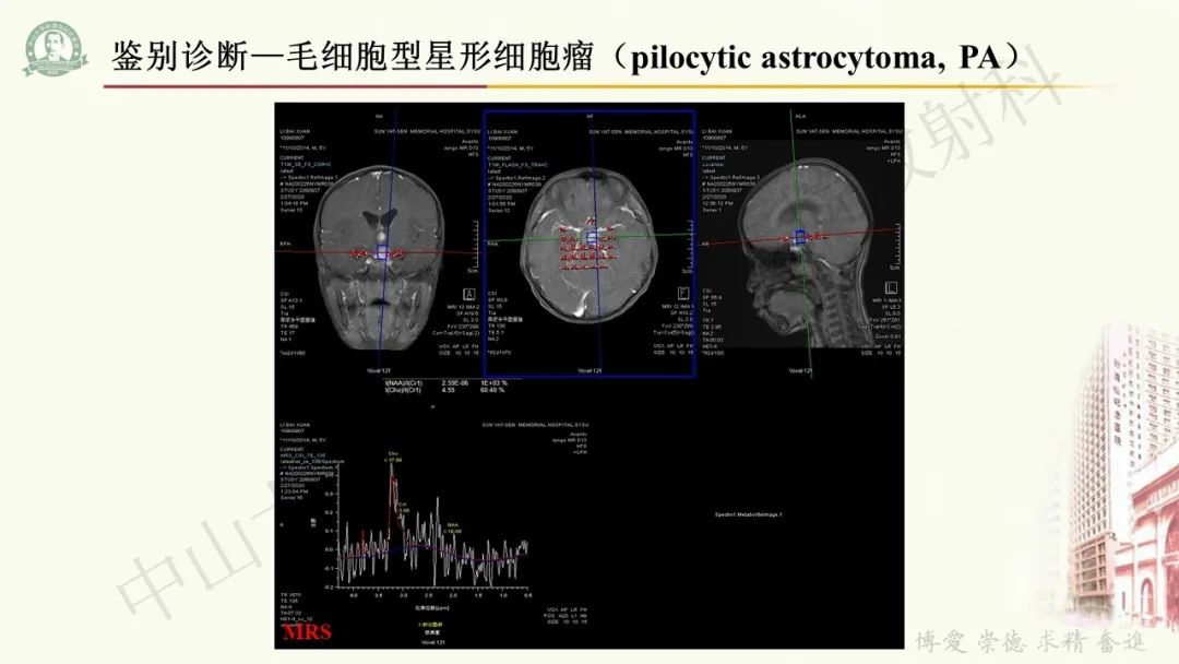影像PPT - 【病例】毛细胞黏液样星形细胞瘤1例CT及MR影像-15