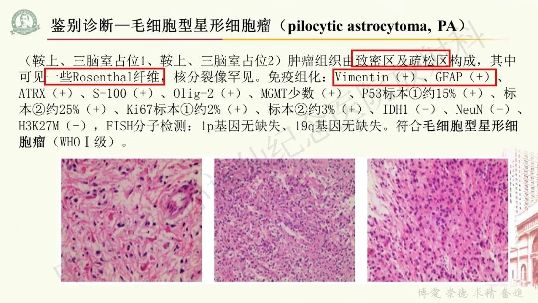 影像PPT - 【病例】毛细胞黏液样星形细胞瘤1例CT及MR影像-16