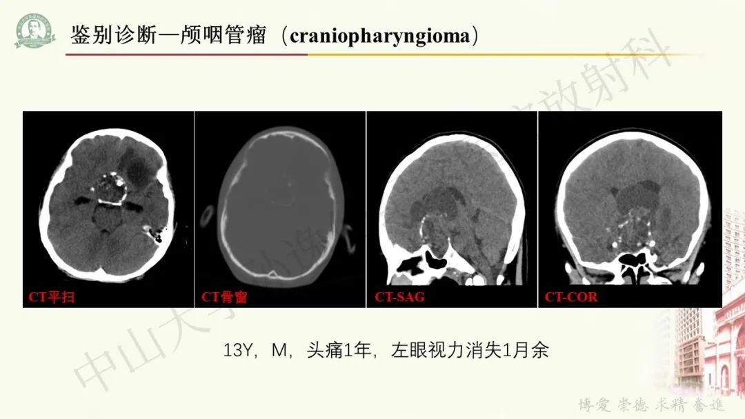 影像PPT - 【病例】毛细胞黏液样星形细胞瘤1例CT及MR影像-19
