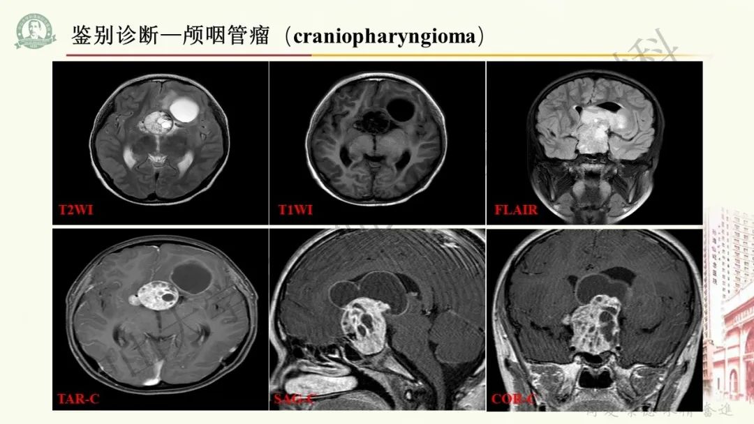 影像PPT - 【病例】毛细胞黏液样星形细胞瘤1例CT及MR影像-20