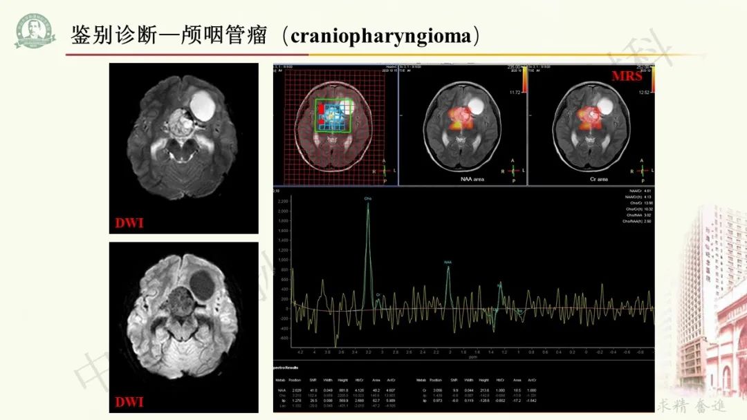 影像PPT - 【病例】毛细胞黏液样星形细胞瘤1例CT及MR影像-21