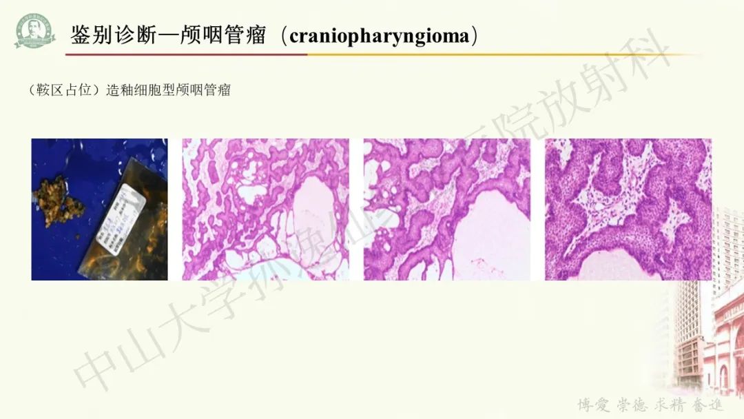 影像PPT - 【病例】毛细胞黏液样星形细胞瘤1例CT及MR影像-22
