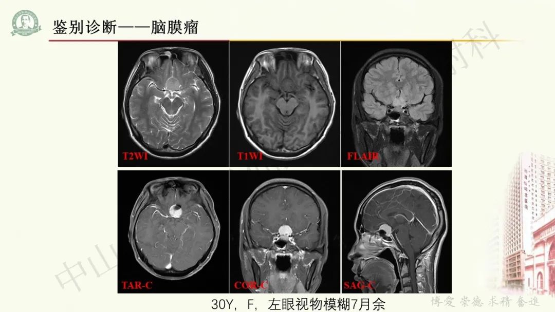 影像PPT - 【病例】毛细胞黏液样星形细胞瘤1例CT及MR影像-24