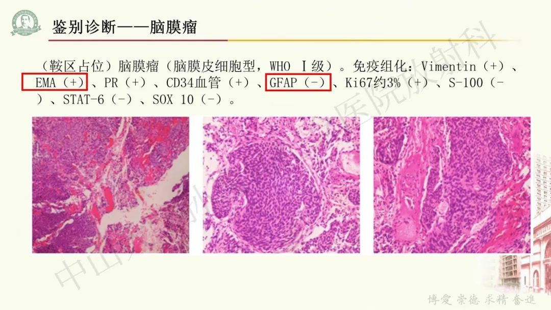 影像PPT - 【病例】毛细胞黏液样星形细胞瘤1例CT及MR影像-25