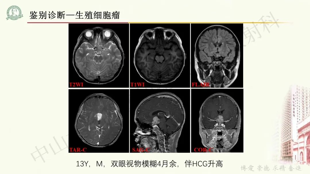 影像PPT - 【病例】毛细胞黏液样星形细胞瘤1例CT及MR影像-27